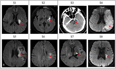 A study of dynamic hand orthosis combined with unilateral task-oriented training in subacute stroke: A functional near-infrared spectroscopy case series